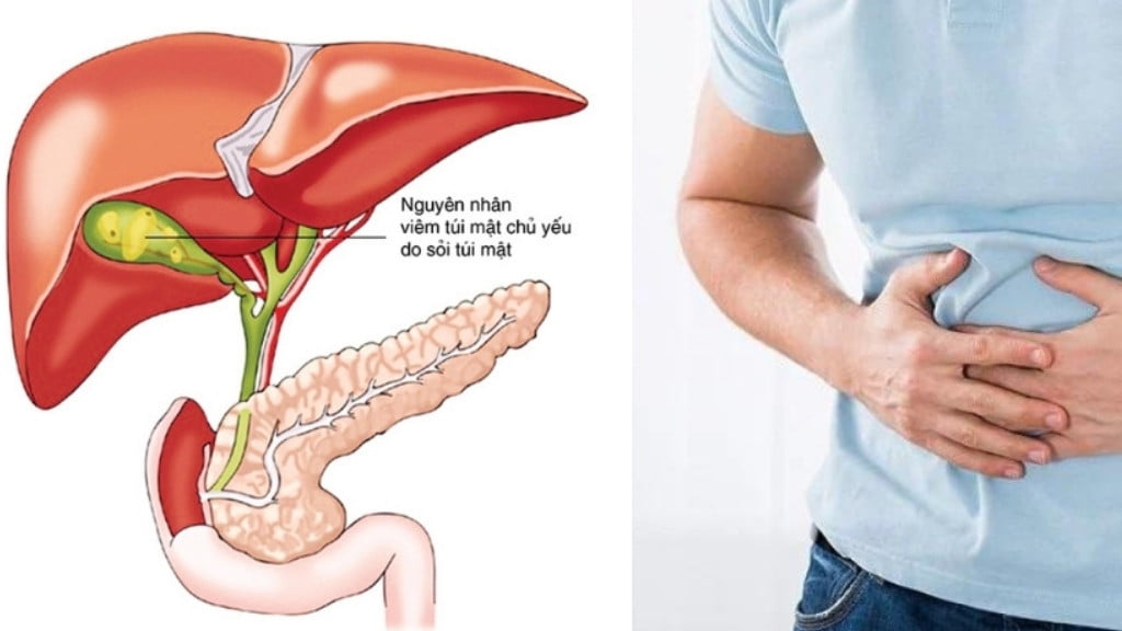 Cách điều trị và phòng ngừa viêm túi mật cấp do sỏi