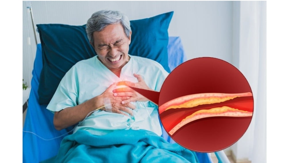 Chuẩn đoán và điều trị xơ vữa động mạch