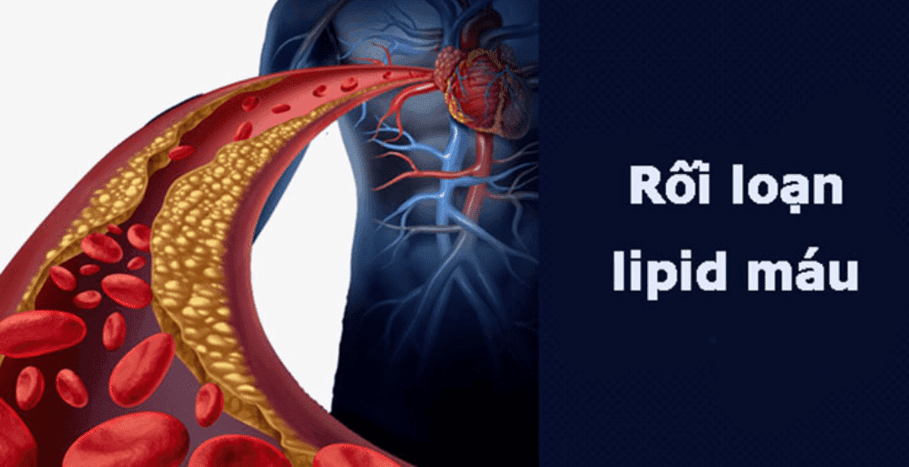 Những điều cần biết về rối loạn lipid máu