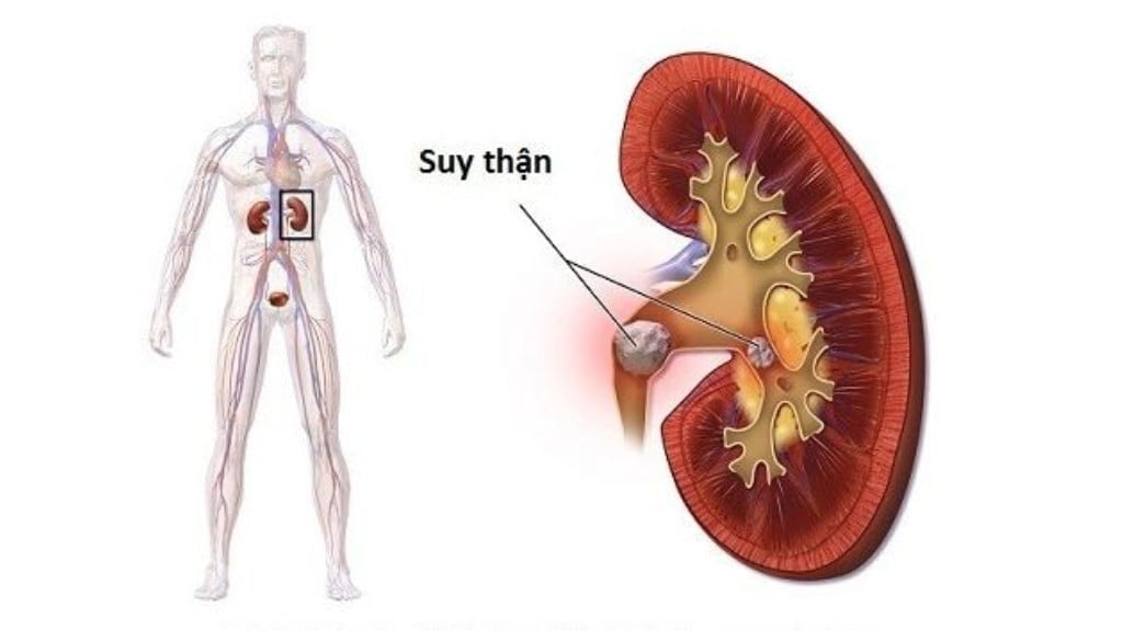 Những dấu hiệu bị suy thận thường gặp mà bạn cần biết