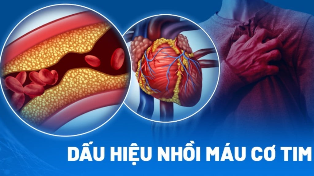 9 dấu hiệu nhồi máu cơ tim cần biết