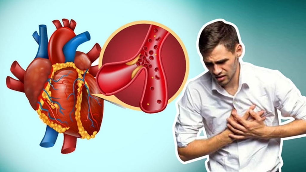 Nhồi máu cơ tim là gì? Nguyên nhân và phương pháp điều trị