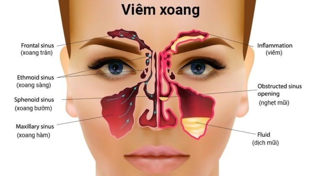 Viêm xoang - Nguyên nhân và triệu chứng của bệnh