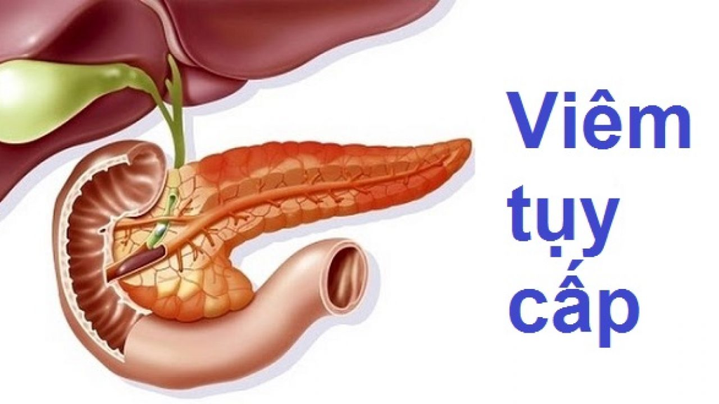 Ngưng thuốc khi nghi ngờ bệnh nhân có dấu hiệu viêm tụy