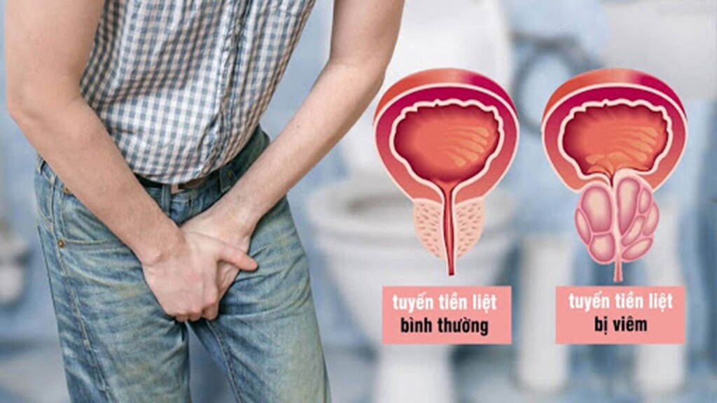 Nam giới trưởng thành ở mọi lứa tuổi đều có thể bị viêm tuyến tiền liệt