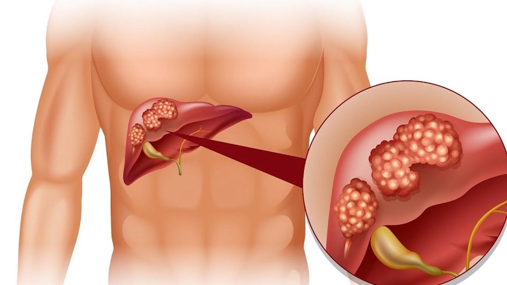 Không khuyến cáo sử dụng Vigorito ở bệnh nhân rối loạn chức năng gan