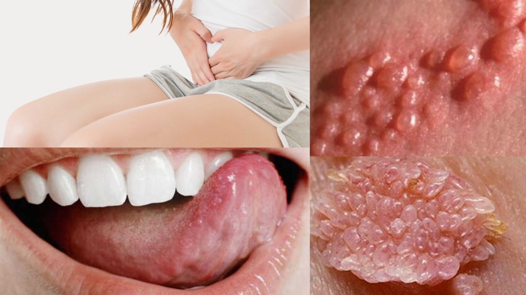 Một vài biểu hiện bị bệnh lậu ở nữ giới