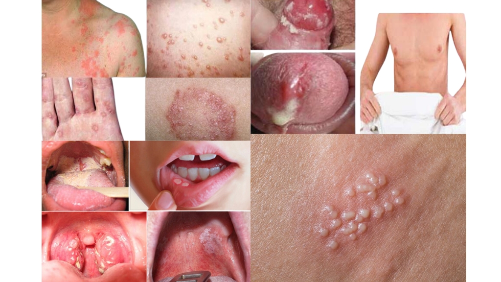 Các biểu triệu chứng bệnh lậu ở nam giới