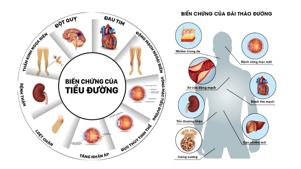 Một số biến chứng thường gặp của bệnh đái tháo đường
