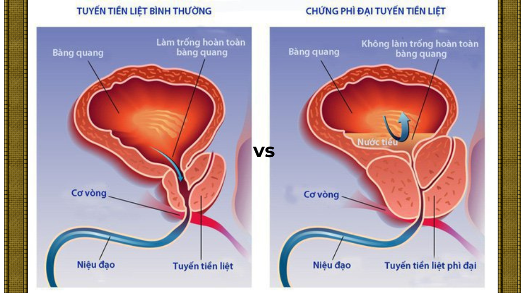 So sánh tuyến tiền liệt lành tính trước và sau khi bị bệnh