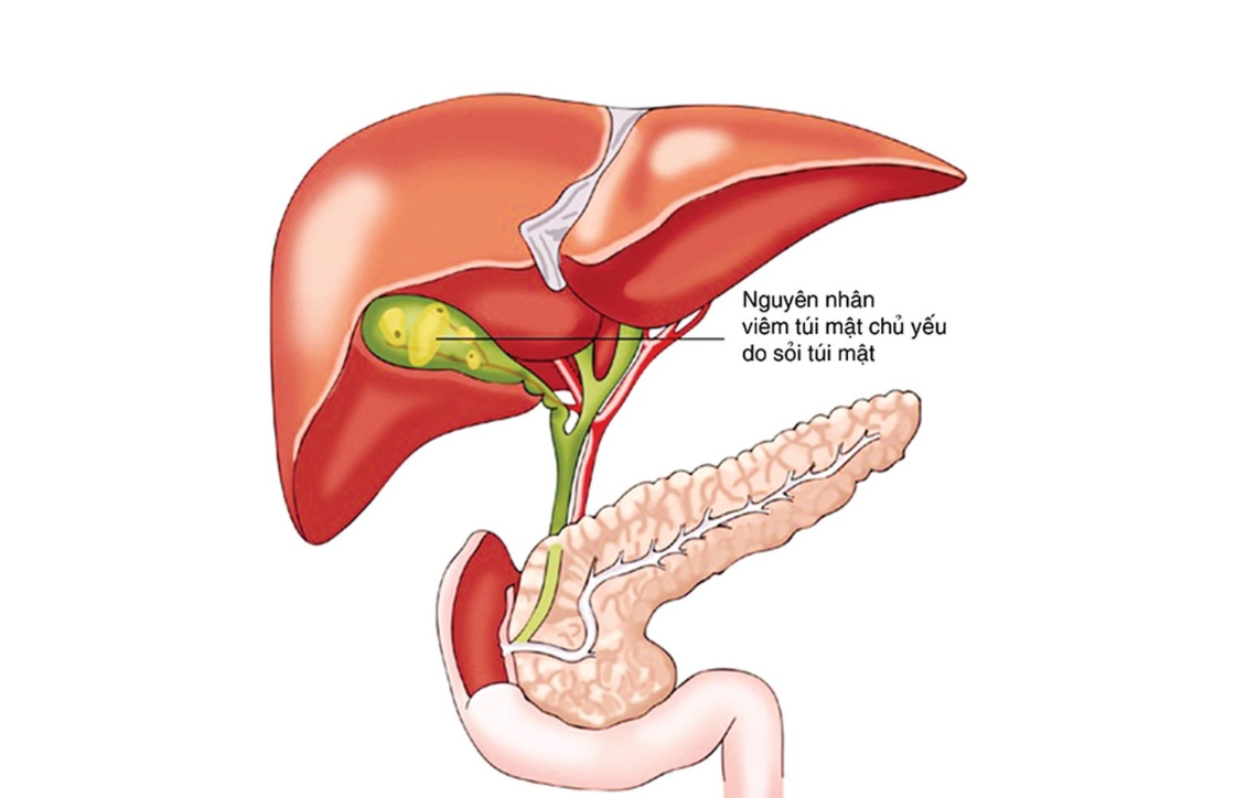 Viêm nhân gây ra túi mật chủ yếu là sỏi túi mật