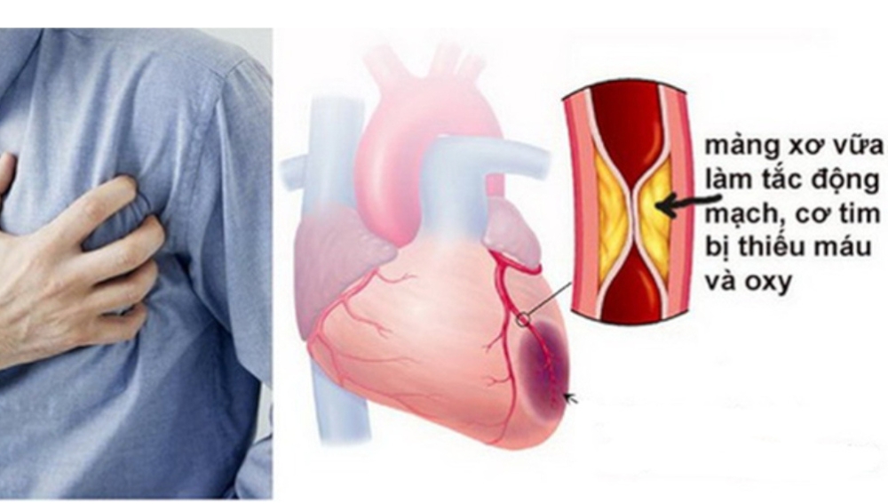 Một số bệnh do xơ vữa động mạch gây ra
