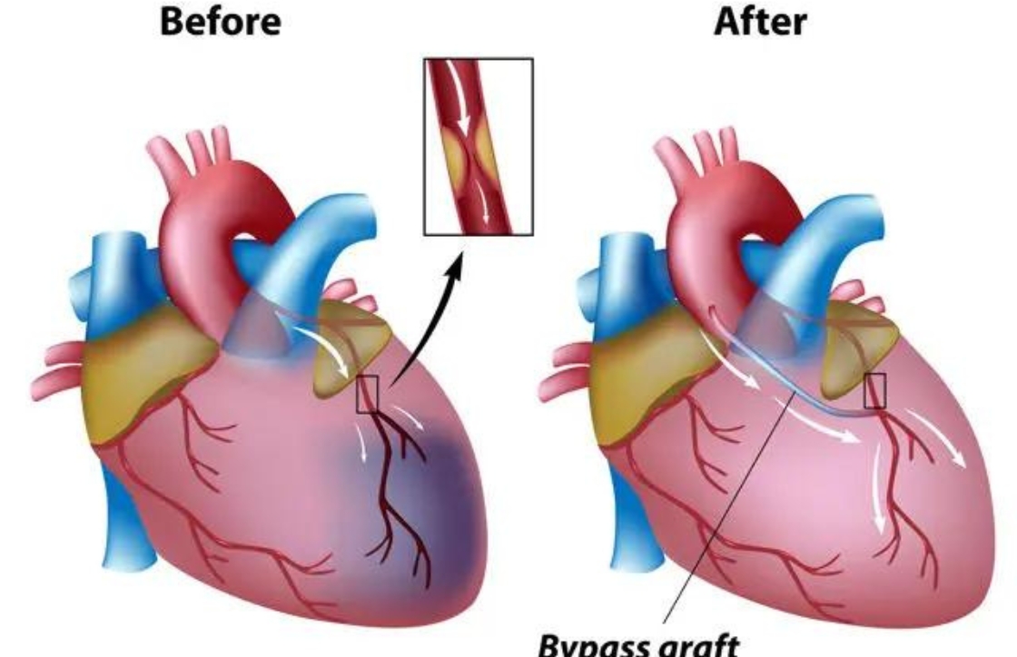 Phương pháp ghép bắc cầu động mạch vành (CABG)
