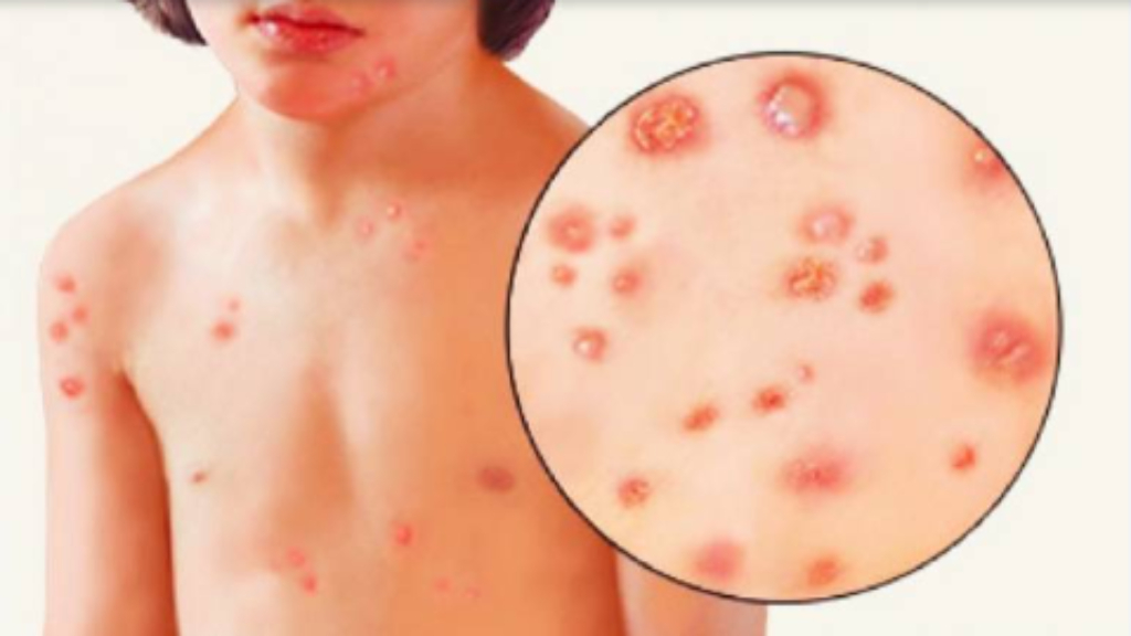 Linliptin 5mg - Thuốc điều trị đái tháo đường tuýp 2 hiệu quả