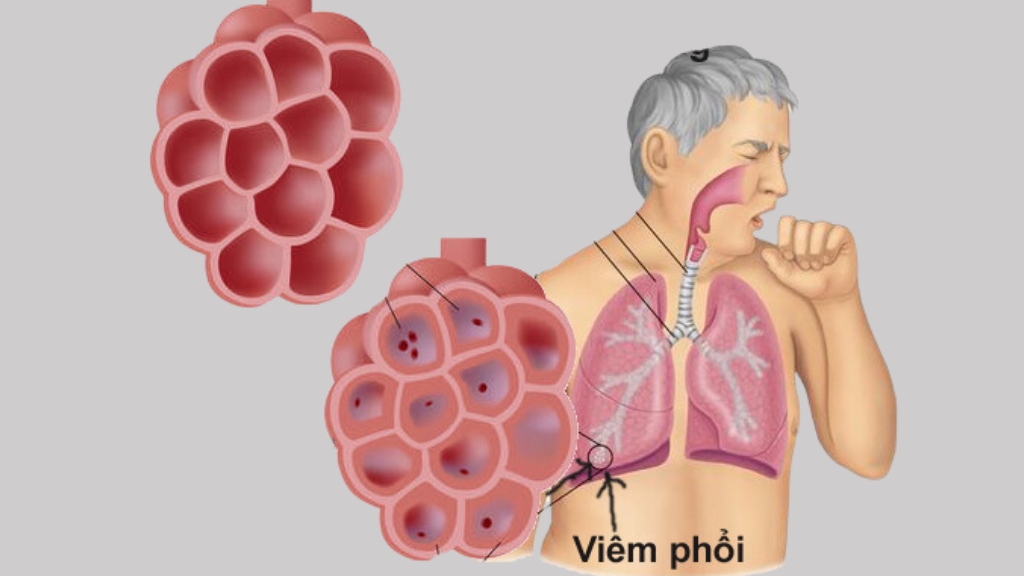 So sánh phổi bình thường và viêm phổi (Bộ Y tế)