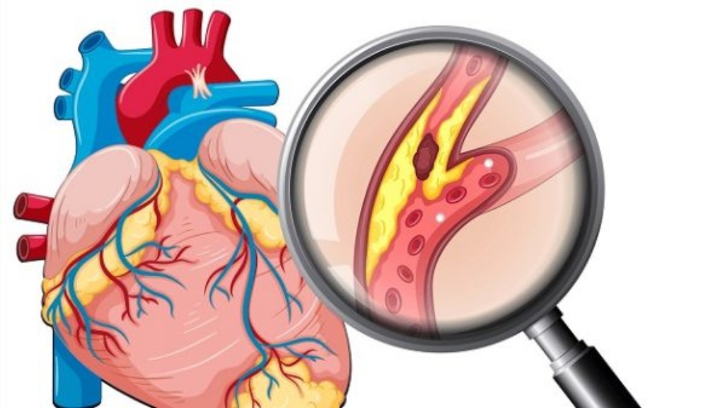 Nguyên nhân phổ biến nhất là do bệnh động mạch vành 