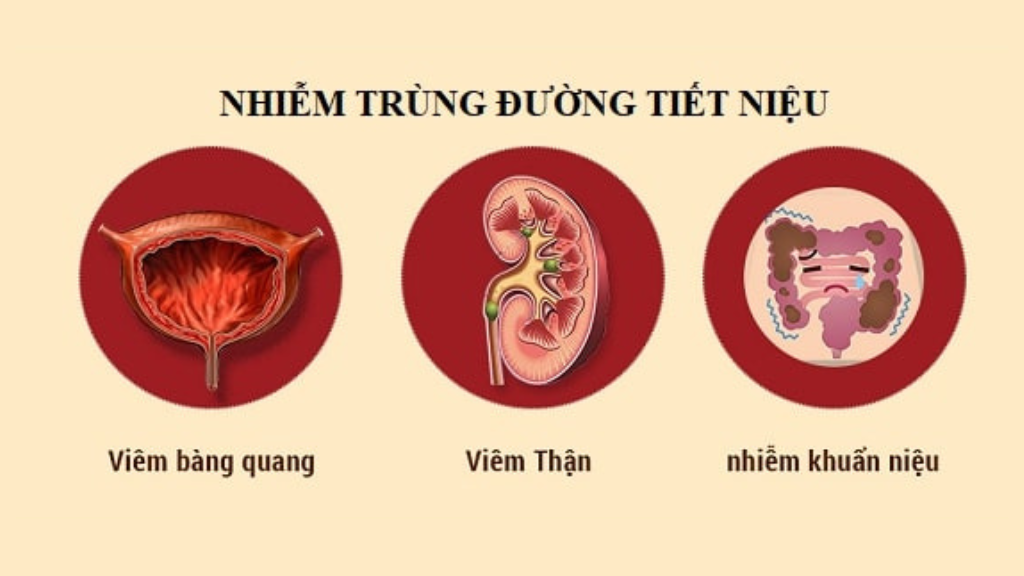 Triệu chứng nhiễm trùng đường tiết niệu
