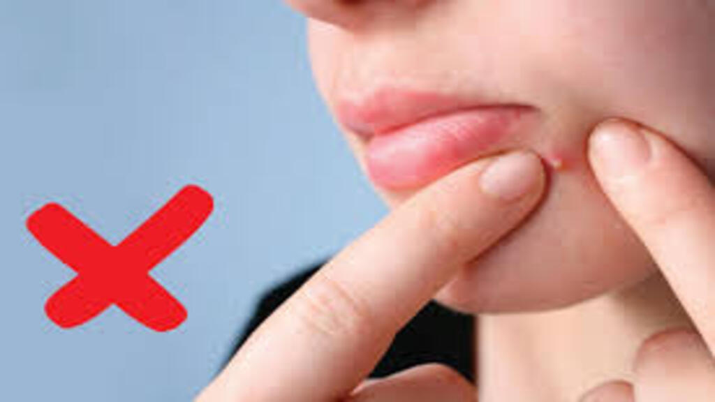 Không nặn mụn để tránh lây lan vi khuẩn sang những vùng da lân cận