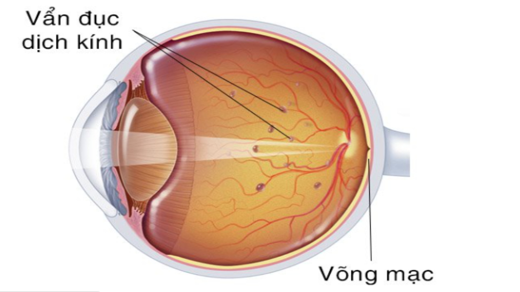 Bệnh võng mạc đái tháo đường: Triệu chứng và cách điều trị