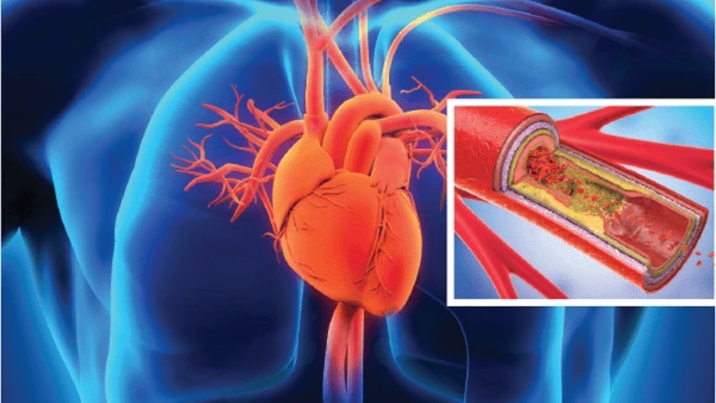 Tăng áp phổi gây tắc nghẽn mạch máu