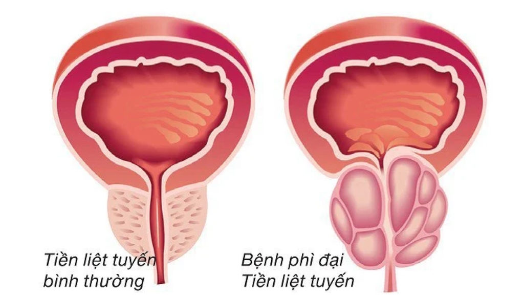 Tiền liệt tuyến tăng sinh
