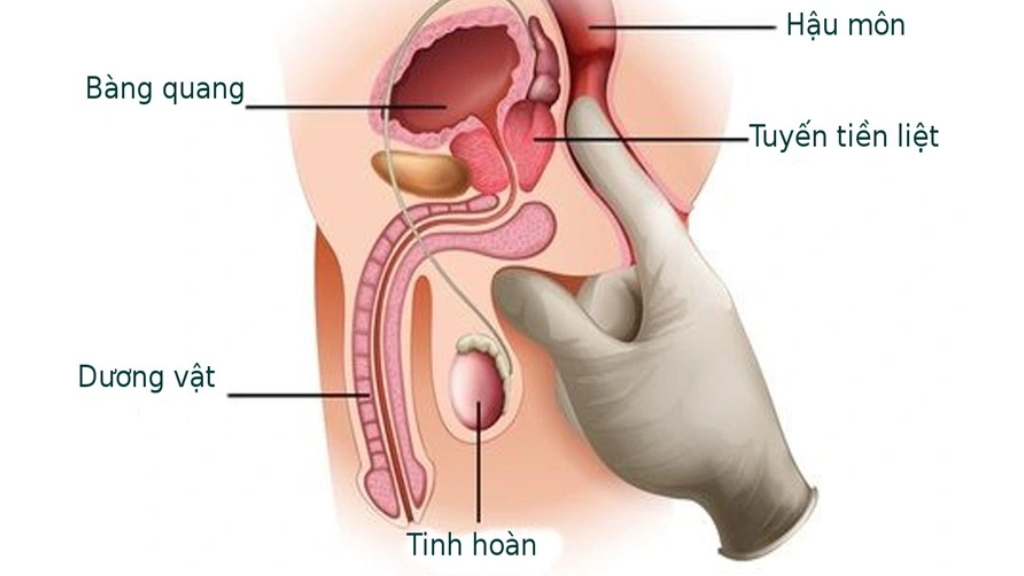 Khám trực tràng để chẩn đoán bệnh tăng sinh tiền liệt tuyến