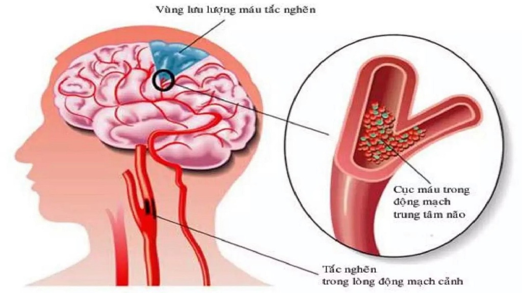 Liệu pháp tiêu huyết khối giúp điều trị sớm đột quỵ do thiếu máu cục bộ.