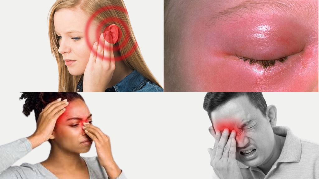 Một số biến chứng do viêm xoang