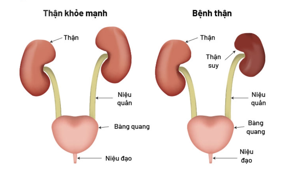 Sự khác biệt giữa thận khoẻ và thận suy