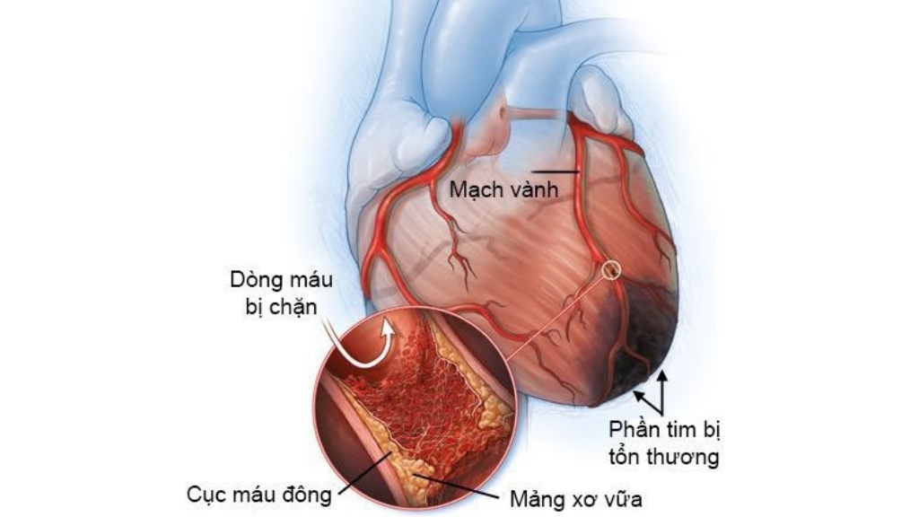 Hình ảnh máu  bị chặn bởi xơ vữa động mạch tim