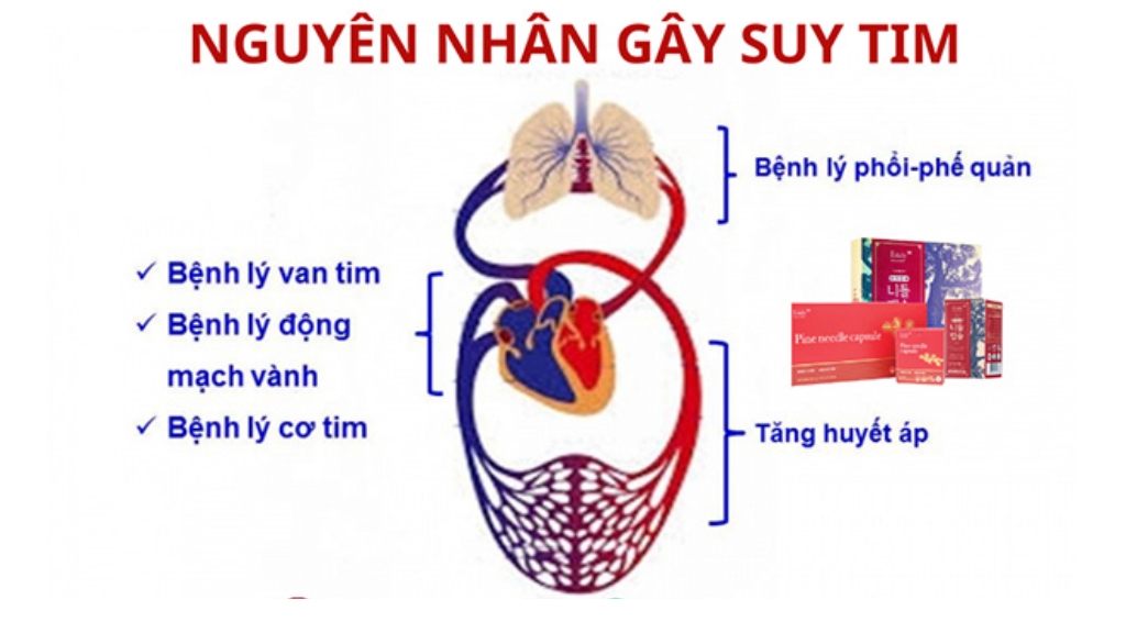 Những nguyên nhân thường gặp gây nên bệnh suy tim