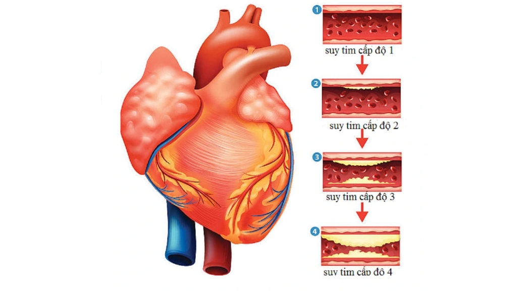 4 cấp độ của bệnh suy tim