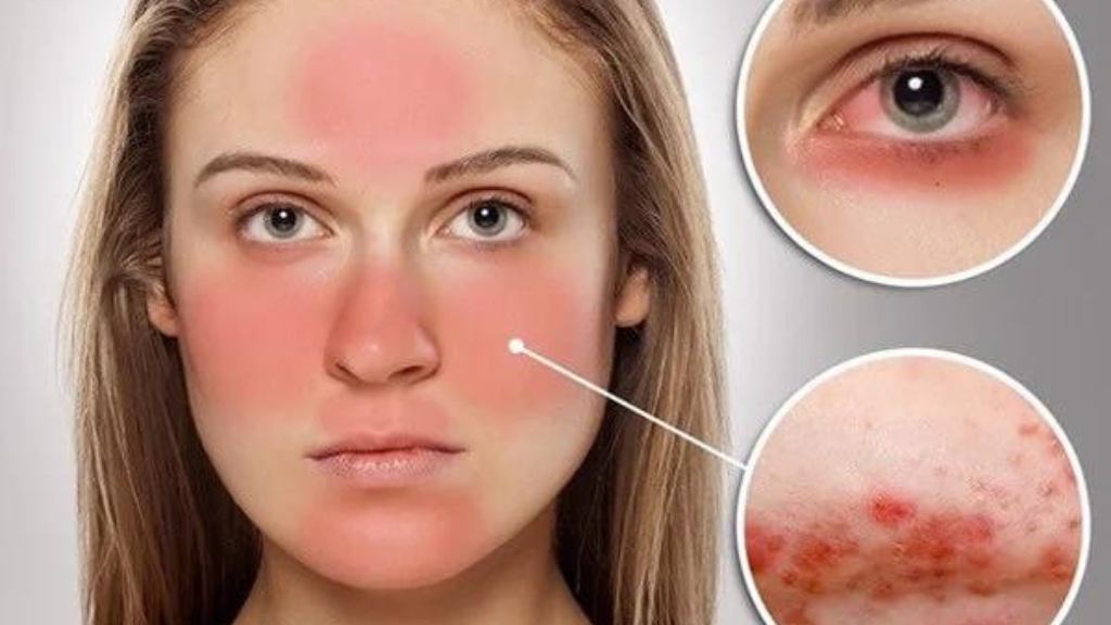 Bệnh lupus ban đỏ hệ thống ảnh hưởng đến tình trạng bệnh suy thận