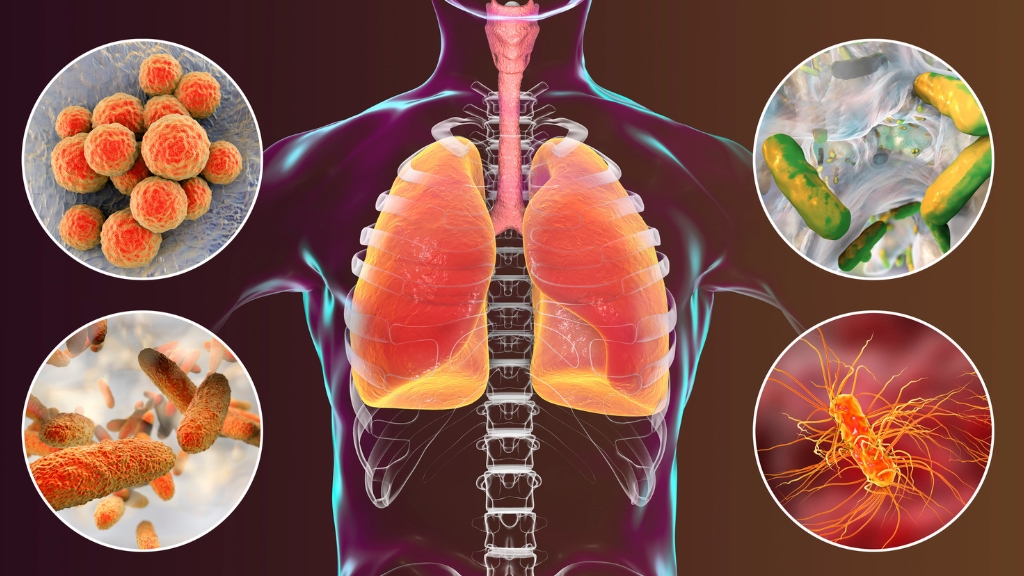 Những vi khuẩn, virus gây viêm phổi ở trẻ em