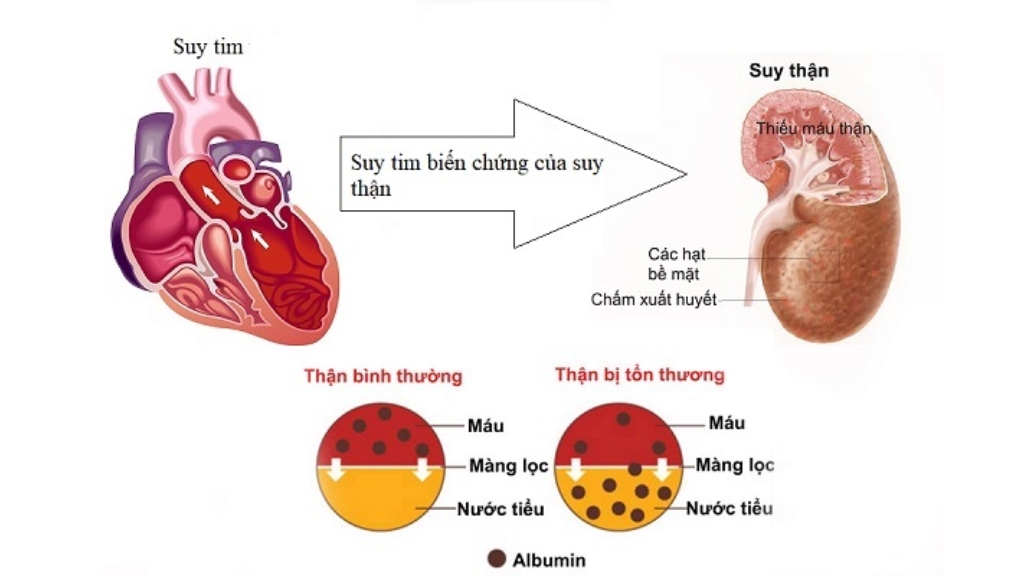 Suy thận là biến chứng nghiêm trọng của suy tim