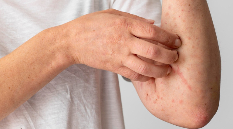 Tổng quan về tình trạng viêm da dị ứng