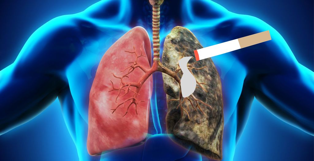 Thuốc lá ảnh hưởng rất xấu đến bệnh viêm phế quản
