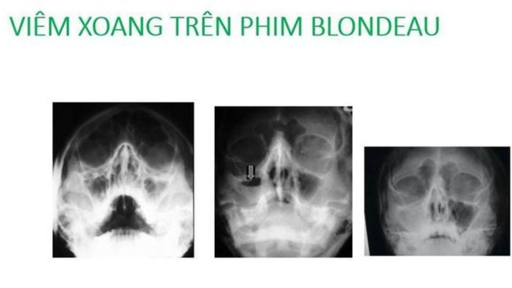 Chuẩn đoán viêm xoang bằng hình ảnh
