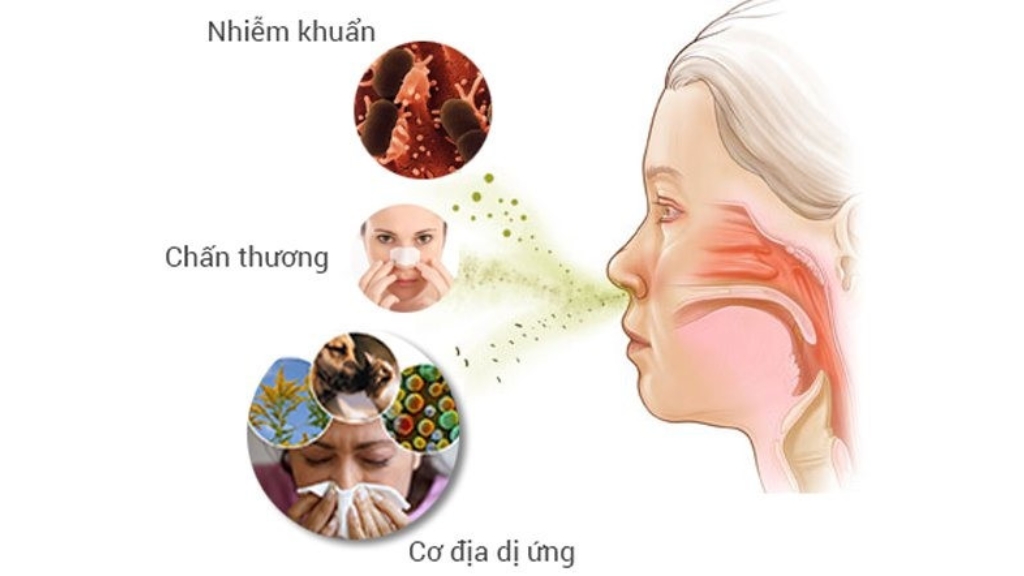 Một số nguyên nhân gây viêm xoang mũi