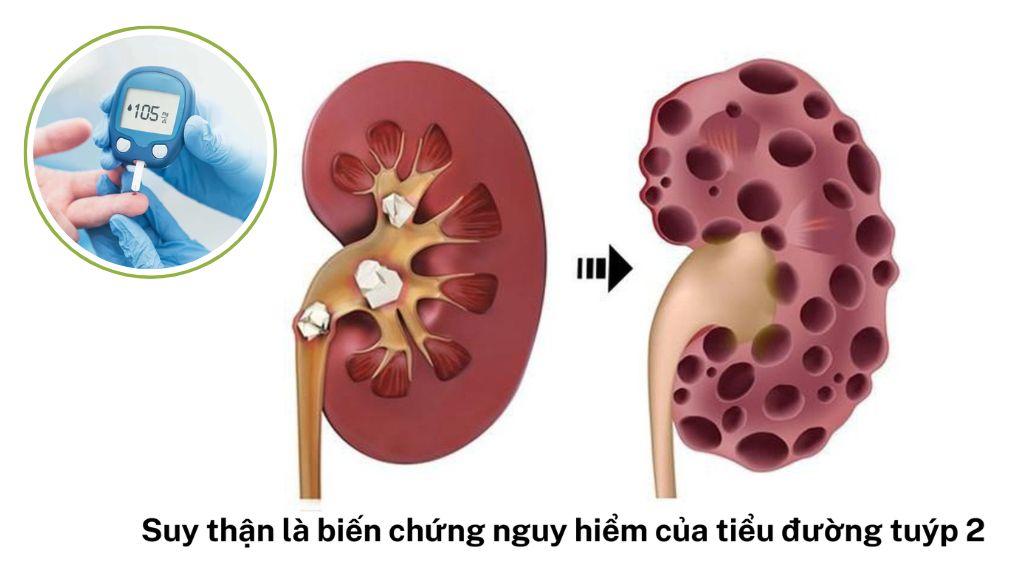 Bệnh đái tháo đường dẫn tới bị suy thận