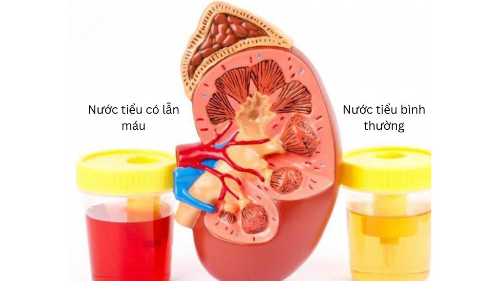 Đi tiểu ra máu là một trong những dấu hiệu cảnh báo suy thận