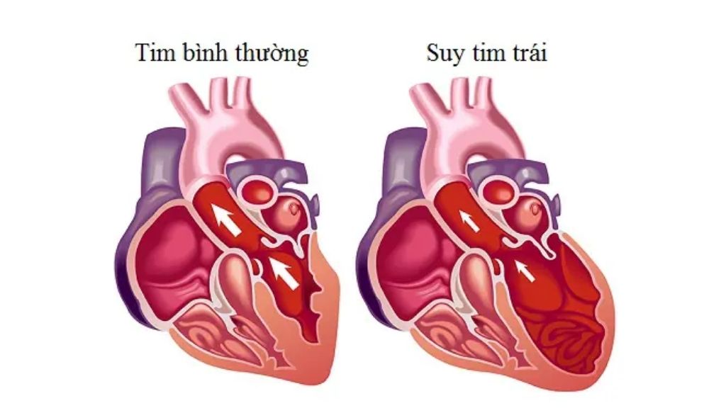 Sự khác biệt giữa trái tim khoẻ mạnh và tim khi bị suy tim