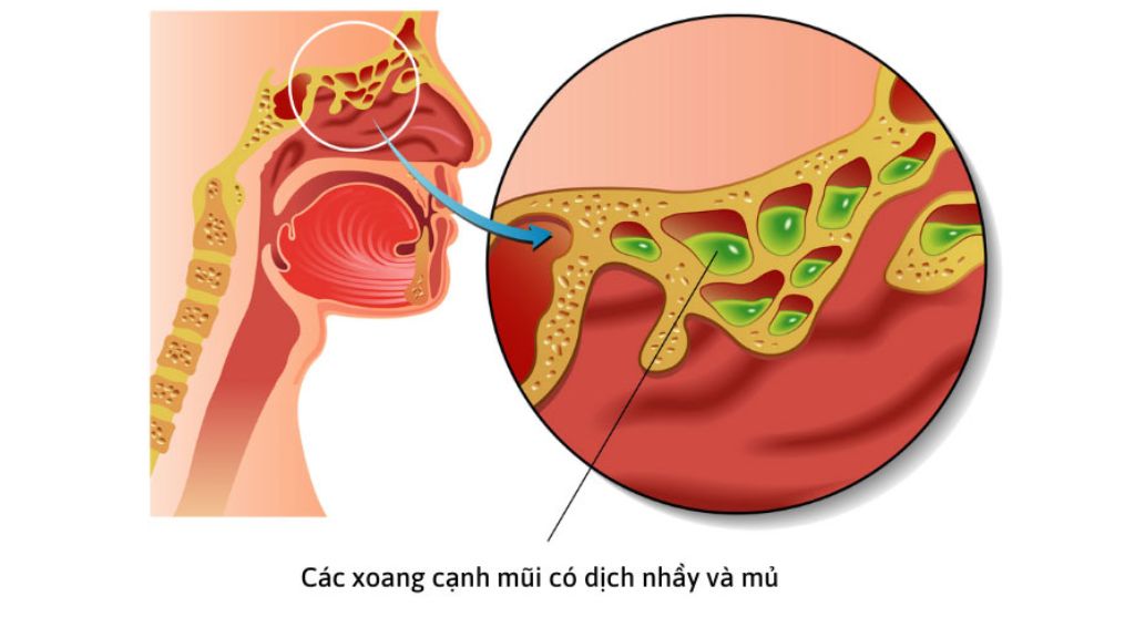 Dịch nhầy ứ đọng vùng xoang mũi